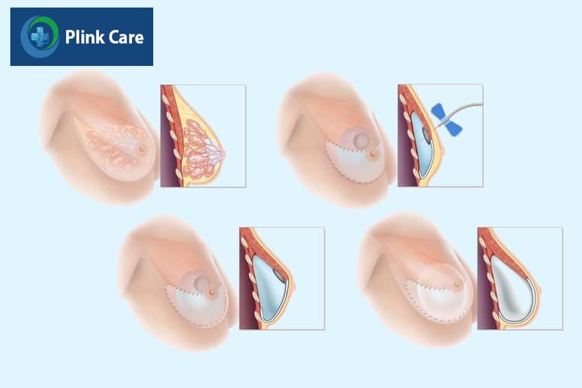 đặt túi ngực có thể ảnh hưởng đến nguồn sữa không