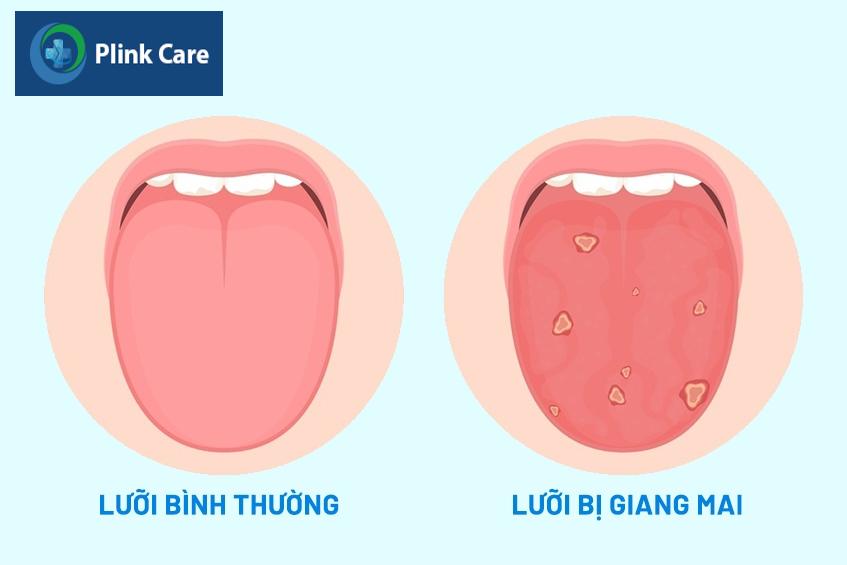 Hình ảnh lưỡi bình thường (bên trái) và lưỡi bị giang mai