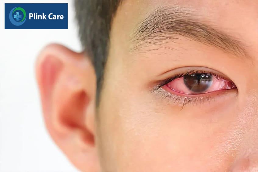 đau mắt đỏ lây qua đường nào