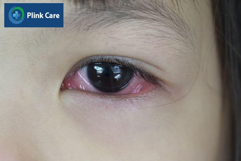 đau mắt đỏ virus