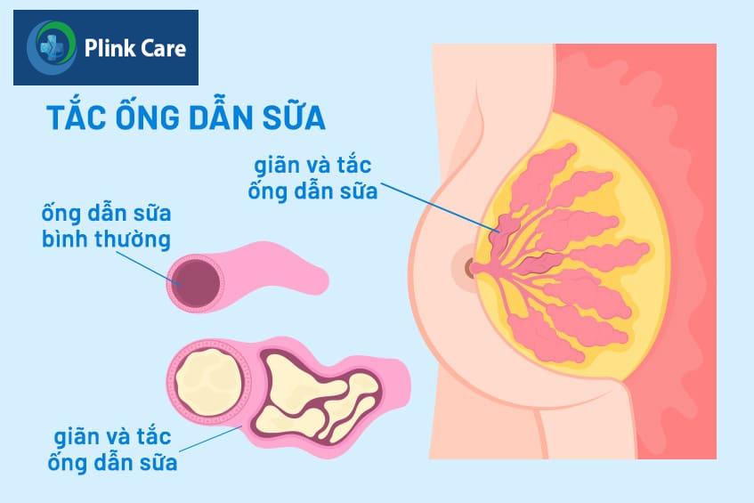 đau nhức dưới vú bên trái