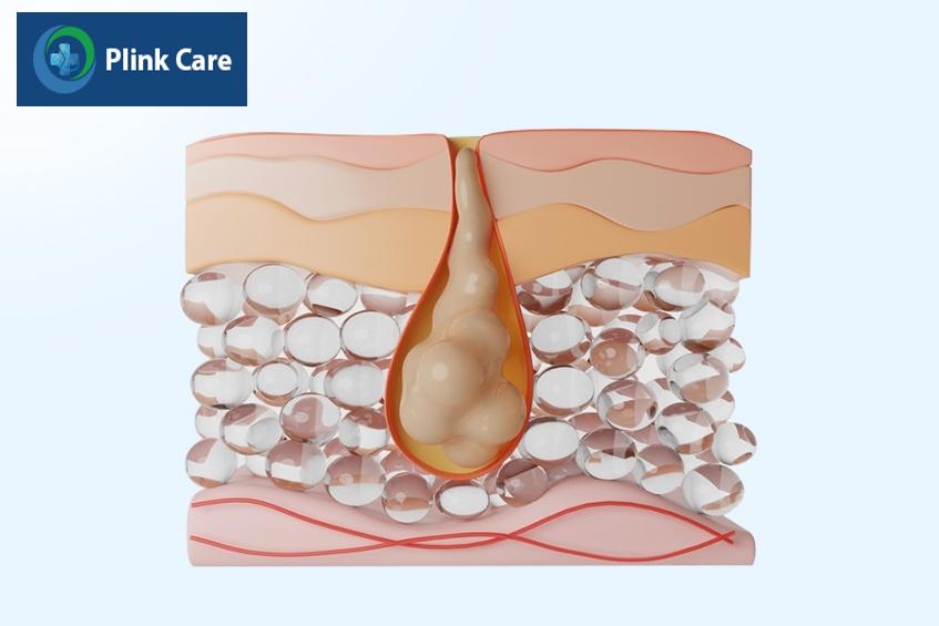Phác đồ điều trị mụn bọc phụ thuộc vào độ tuổi và tình trạng mụn