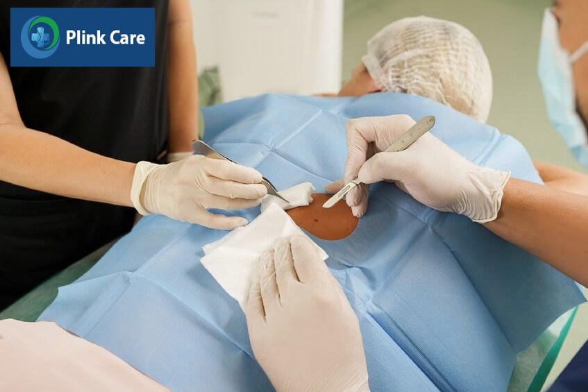 cách điều trị ung thư hắc tố da bằng phẫu thuật