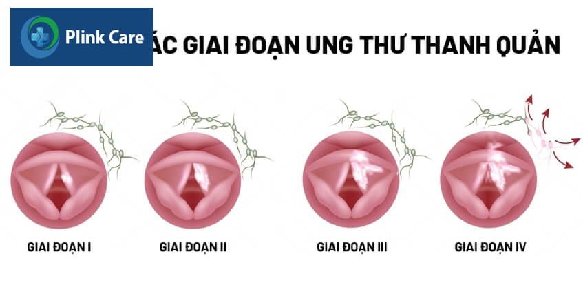 giai đoạn 1 các giai đoạn ung thư thanh quản