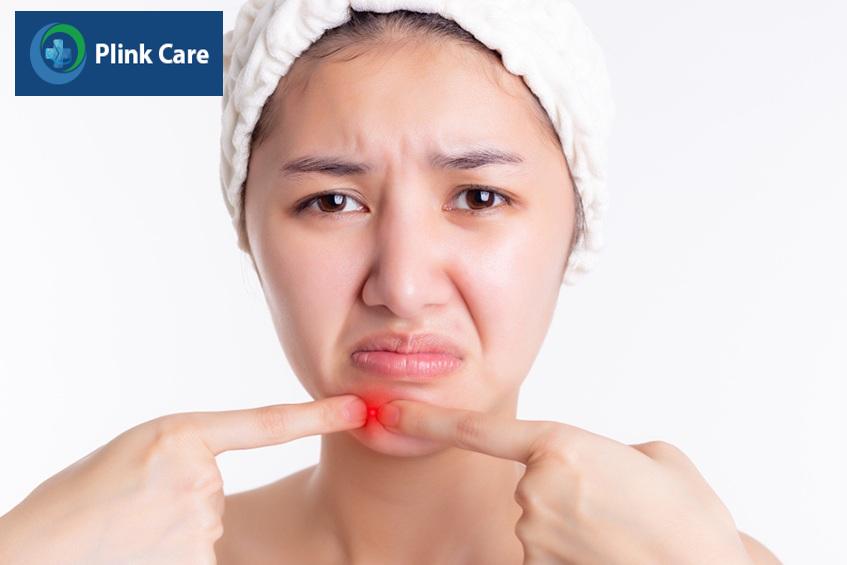 không nên nặn mụn bọc ở cằm