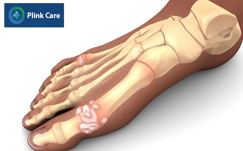 khớp bàn chân bị viêm và sưng tấy