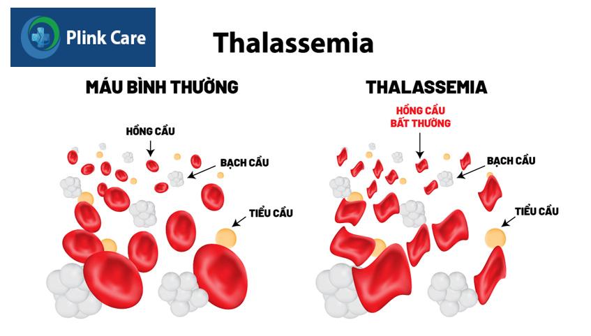 máu của người bệnh thalassemia