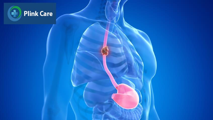 mô phỏng bệnh ung thư thực quản giai đoạn 3