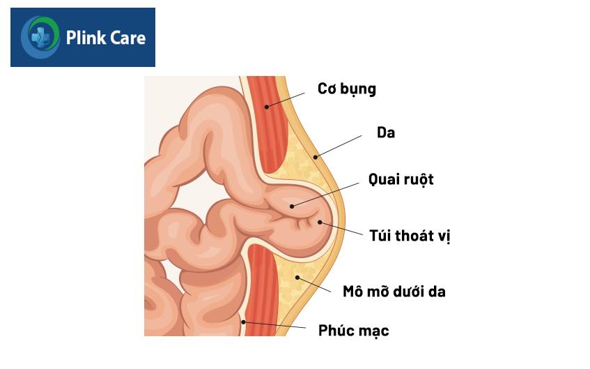 mổ thoát vị bẹn là gì