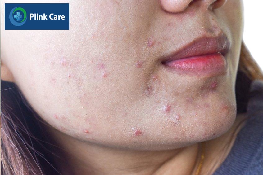 mụn bọc ở cằm vì thức khuya