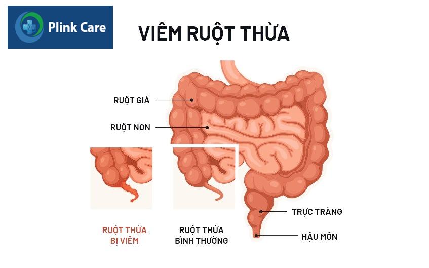 nguyên nhân đau ruột thừa