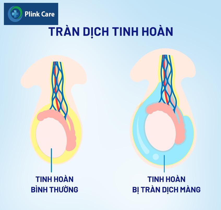 Tràn dịch màng tinh hoàn là một nguyên nhân khiến trẻ bị sa tinh hoàn