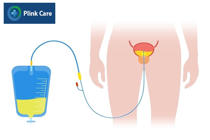 ống thông tiểu nữ là gì