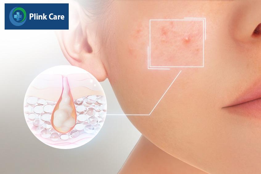 Peel da là dùng chất hóa học để tẩy tế bào chết trên da, điều trị mụn bọc, hạn chế được sẹo và thâm sau mụn