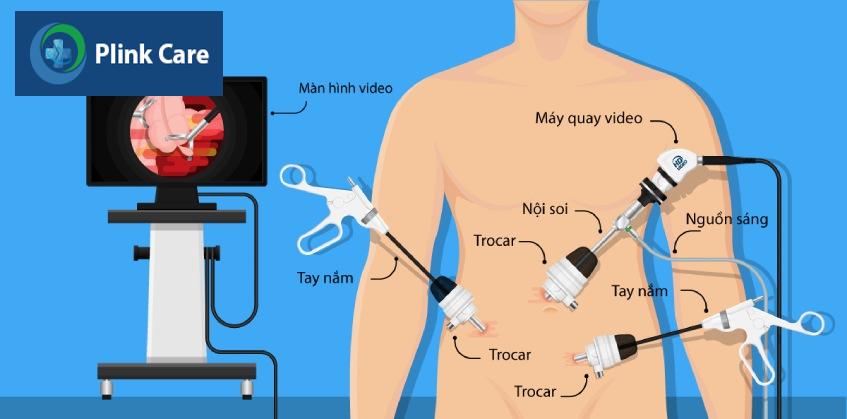 phẫu thuật nội soi cắt ruột thừa