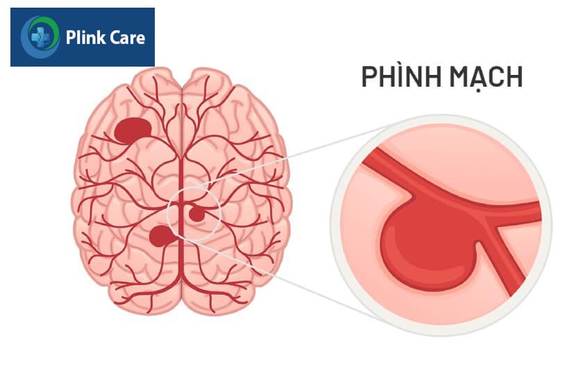 phình mạch não gây đau đầu ho