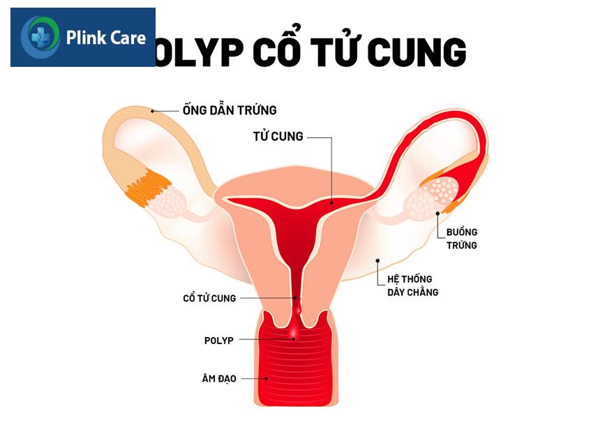 polyp cổ tử cung