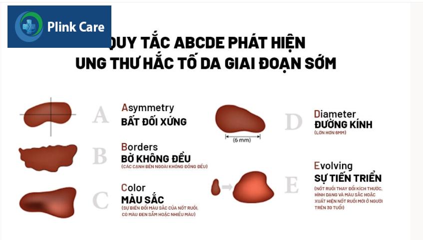 quy tắc abcde phát hiện ung thư hắc tố da