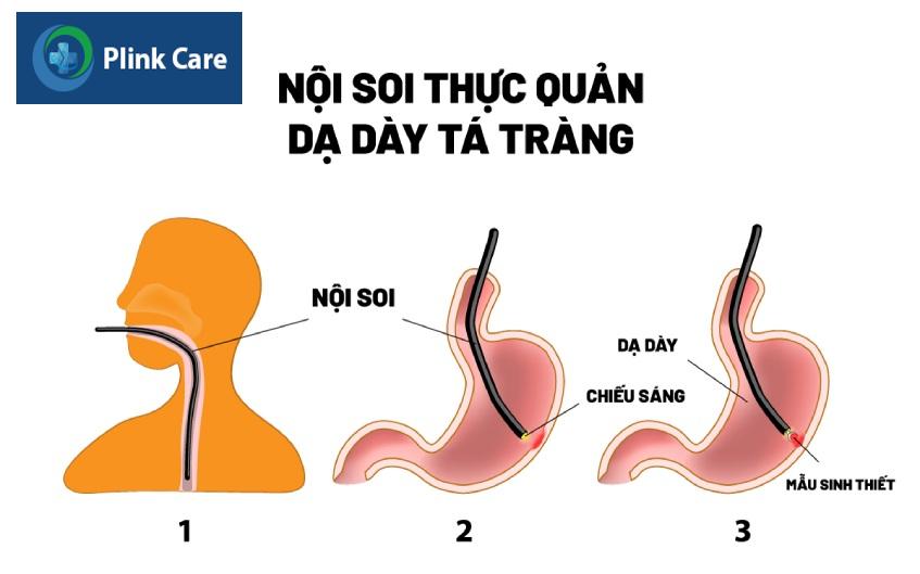 quy trình sinh thiết dạ dày