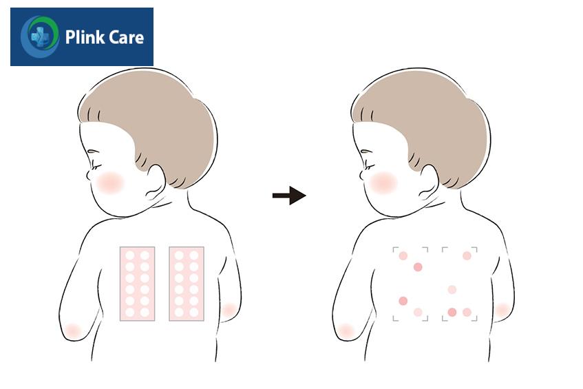 quy trình thực hiện patch test