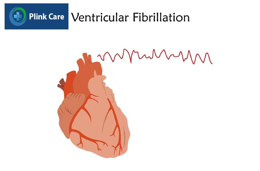 Rung tâm thất (VF) được biểu hiện bằng các gợn sớm nhỏ siêu nhanh, không đồng đều về thời gian và hình thái trên điện tâm đồ (ECG)