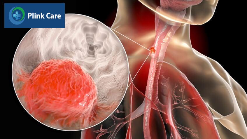 tiên lượng giai đoạn ung thư thực quản