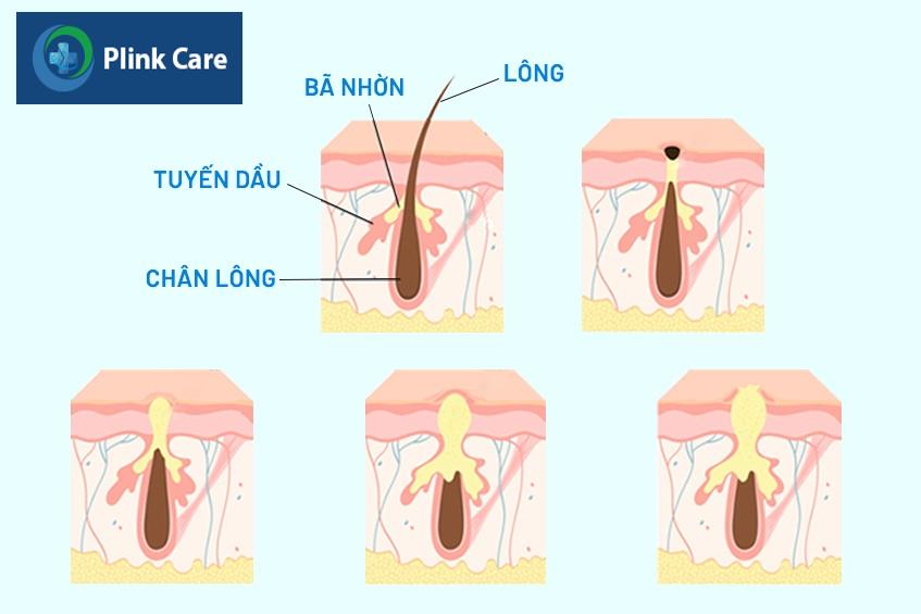 Tình trạng lỗ chân lông bít tắc, gây nổi mụn bọc