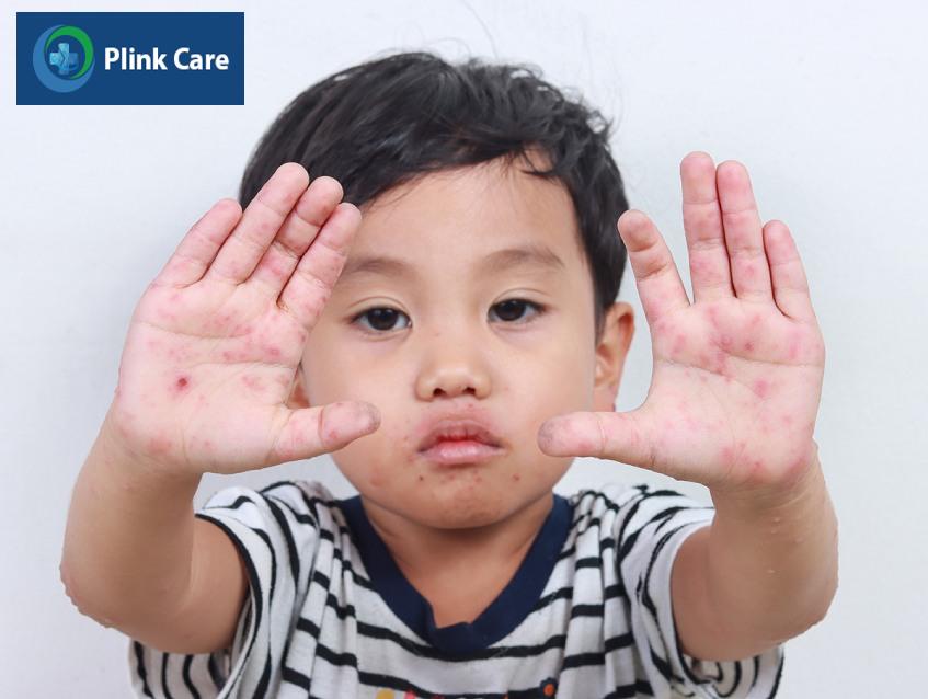 Trẻ mệt mỏi, lờ đờ, xuất hiện nhiều nốt mụn nước