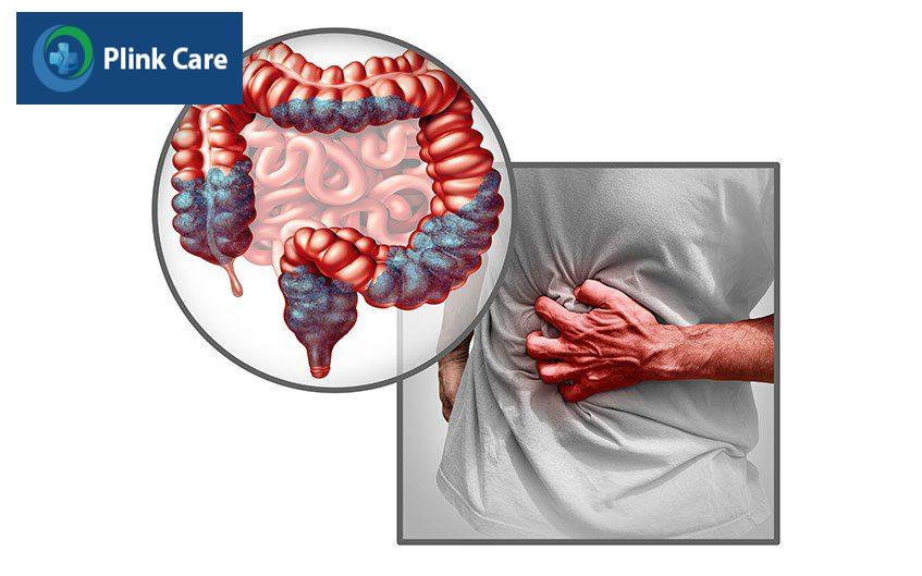 trị hội chứng ruột kích thích