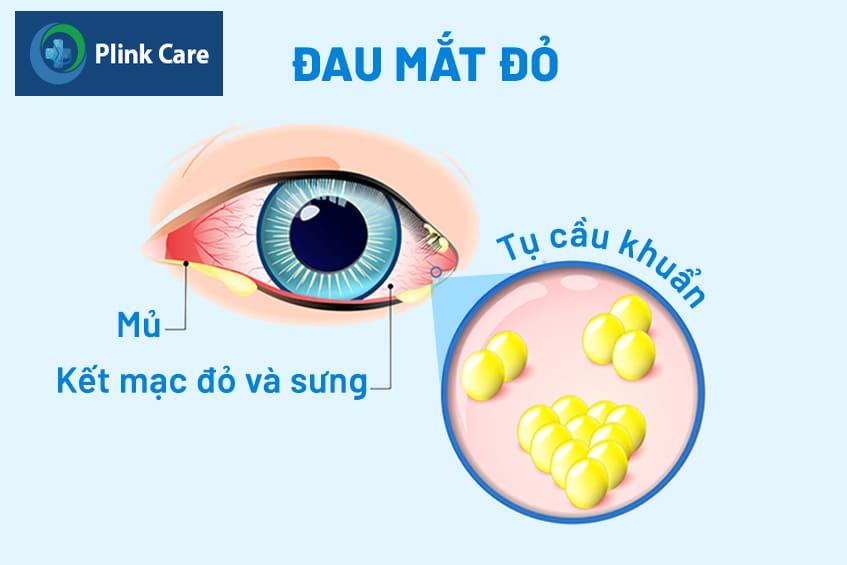 triệu chứng đau mắt đỏ