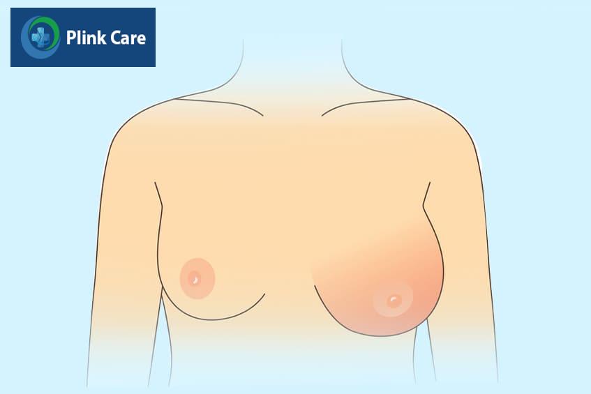 Triệu chứng nhiễm trùng túi ngực