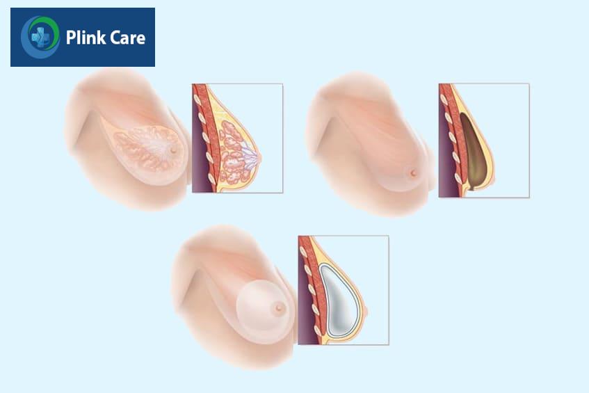 túi ngực đối với nguồn sữa