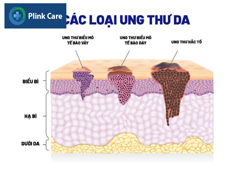 ung thư hắc tố da và các loại ung thư da