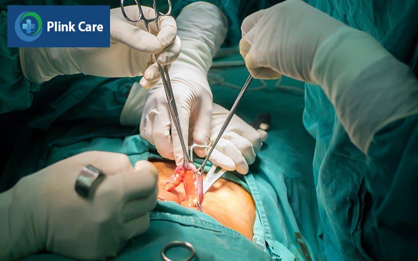 viêm ruột thừa có phải mổ không