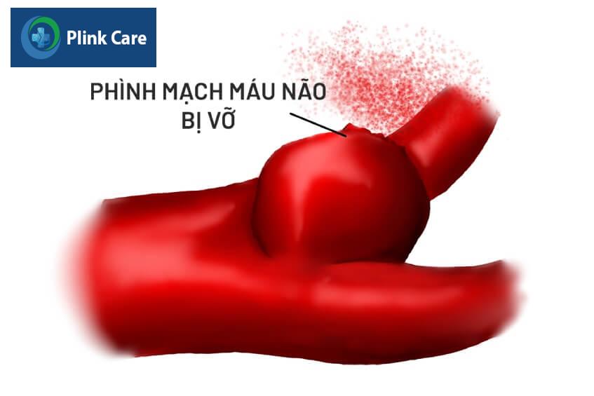vỡ túi phình mạch máu não gây nguy hiểm