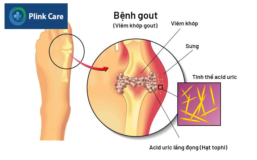 bệnh gout gây viêm sưng ngón chân cái