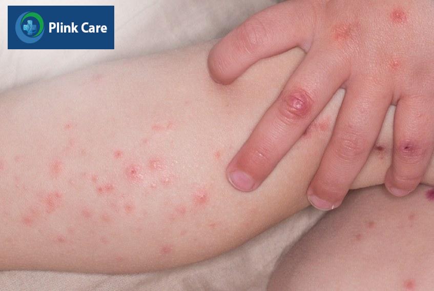 Bệnh tay chân miệng được chia làm 4 cấp độ