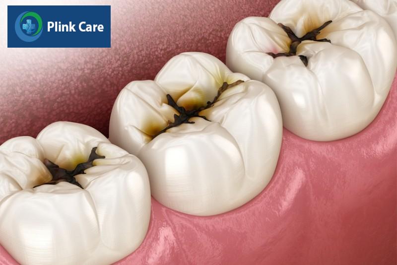 Các yếu tố nguy cơ gây sâu răng