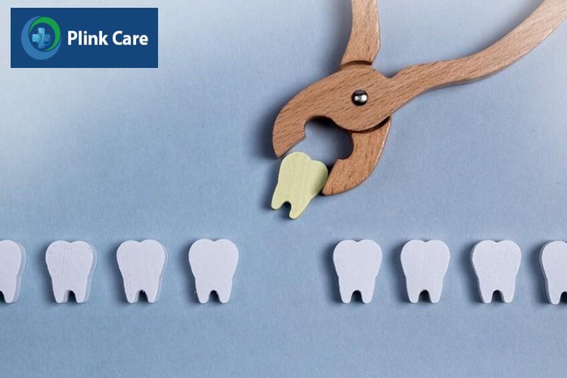 Các biến chứng sau nhổ răng có thể gặp phải