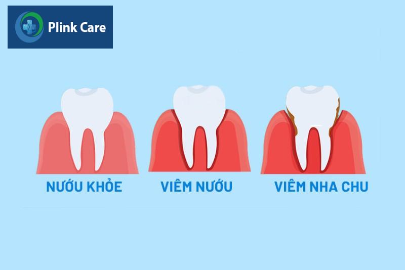 Các bệnh về lợi thường gặp, viêm nướu, viêm nha chu