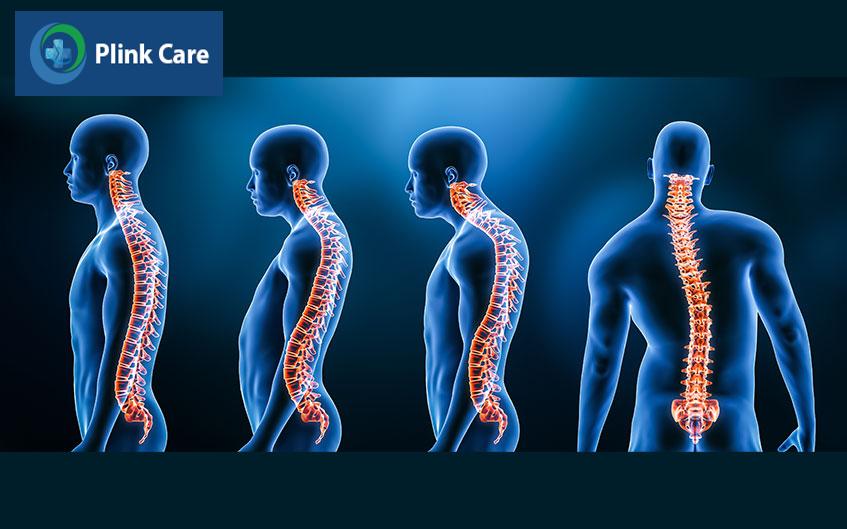 các dạng vẹo cột sống thường gặp