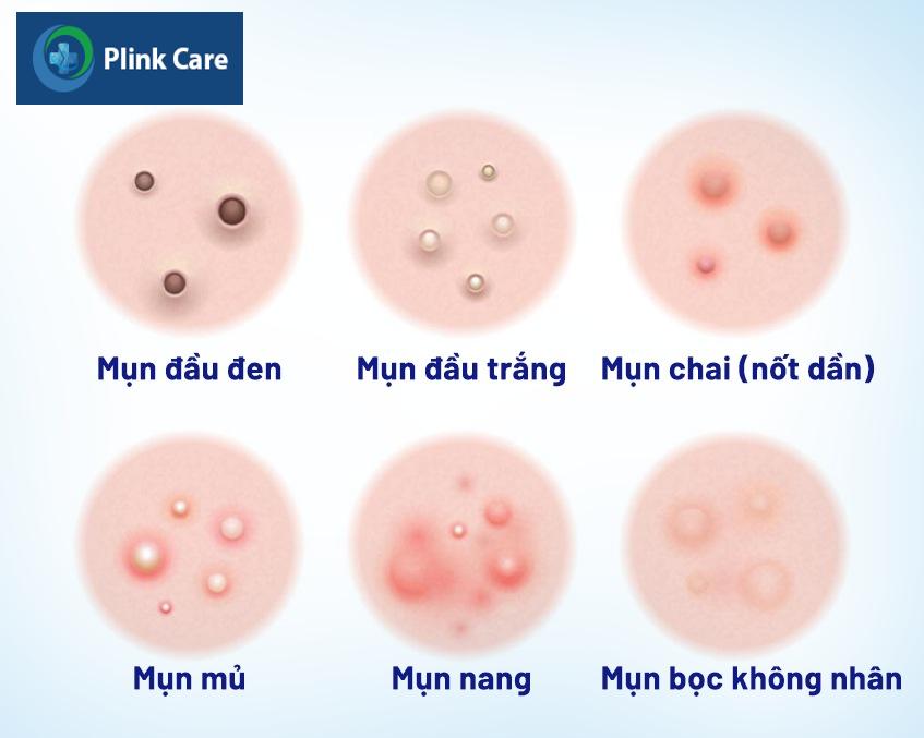 Các loại mụn bọc thường thấy