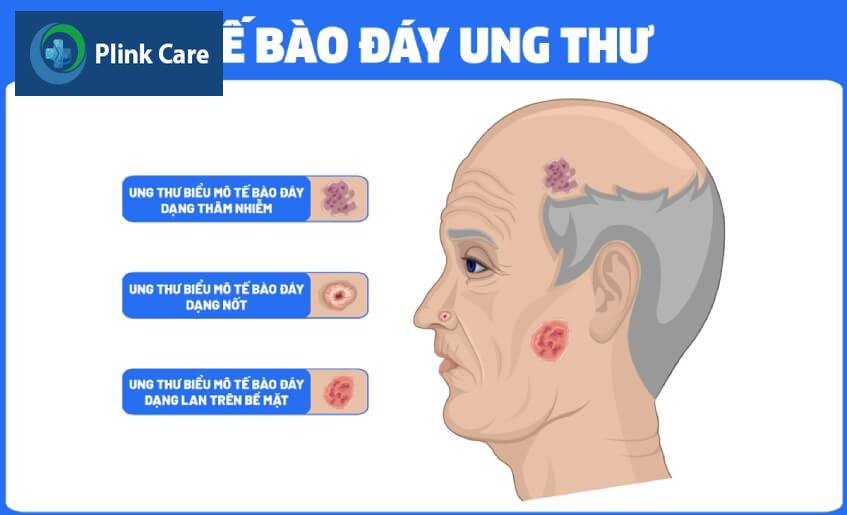 các loại ung thư da biểu mô tế bào đáy
