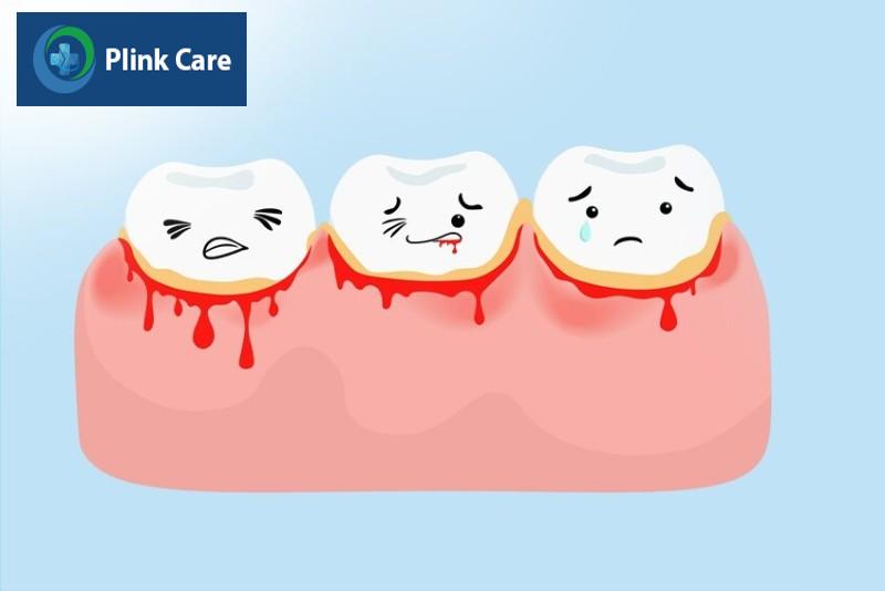 Chảy máu chân răng là bệnh gì?
