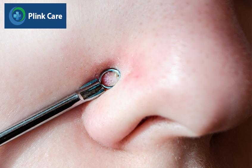 Chỉ sử dụng lực nhẹ để nặn mụn cám