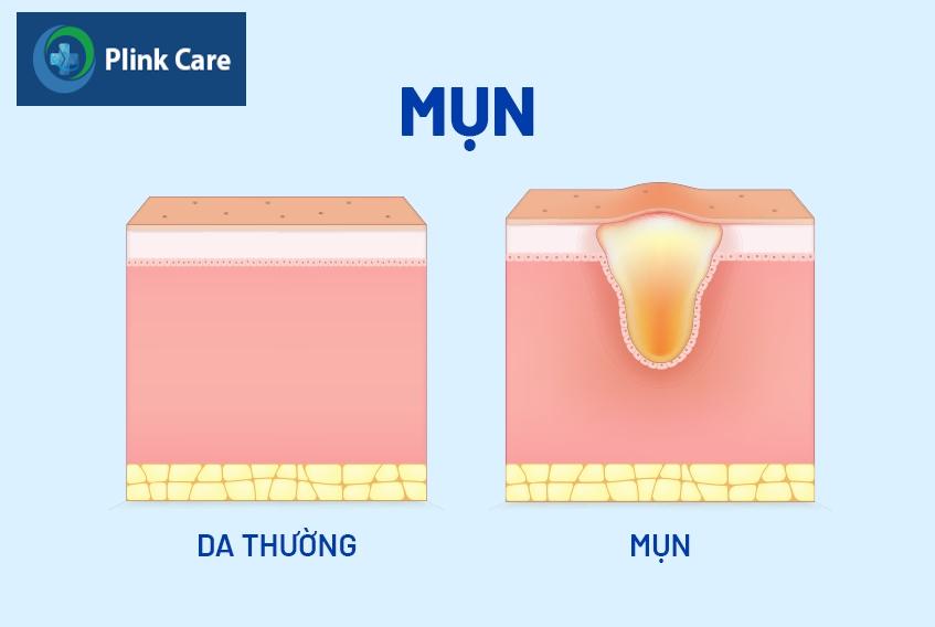 Mụn ẩn nằm bên dưới da thường khó phát hiện, chỉ sờ thấy cộm trên da