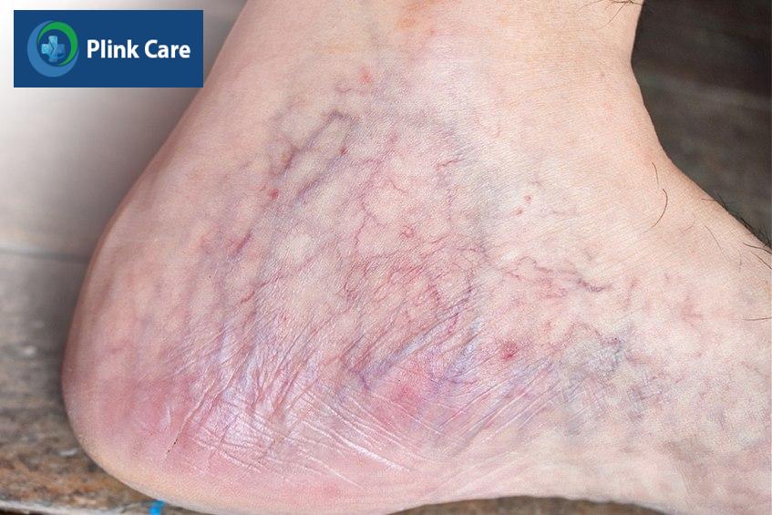Dấu hiệu da nhiễm corticoid trong thời gian dài
