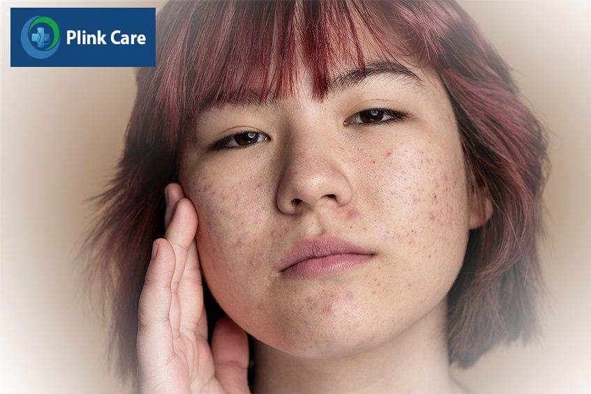 Mụn ẩn thường gặp trên da nên cần điều trị sớm.