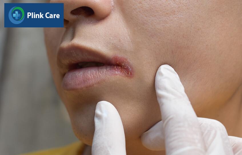 dấu hiệu ung thư biểu mô tế bào vảy