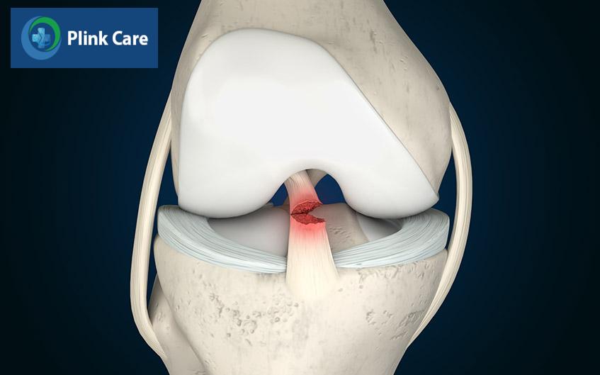 dây chằng acl bị đứt